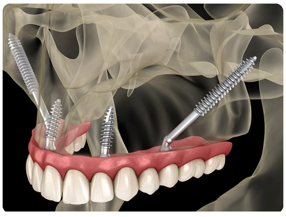 Smile Makeovers with High-Tech Equipment